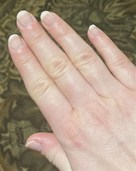 Tips for healing this finger? (Damaged from compulsive nail biting and