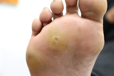 Corn Forming On Foot Sale | emergencydentistry.com