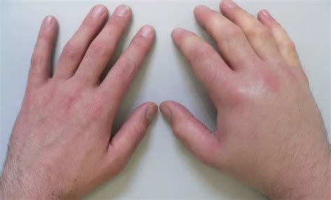 Arthralgia - Symptoms, Arthralgia Of The Knee Joint In Children | Diseases