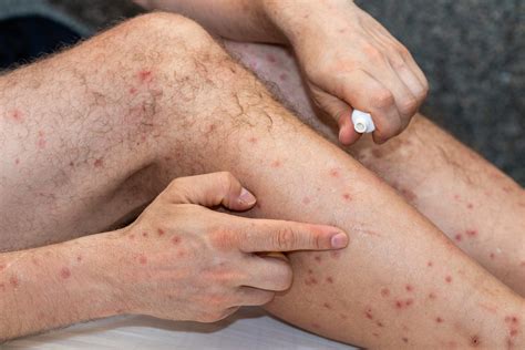 sandflies tiny bites  strong reactions katu dermatology clinic