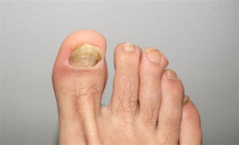 Micosi sulle unghie dei piedi? Elimina il fastidio con questi efficaci ...