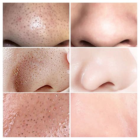 LANBENA Beauty Skin Care Blackhead Remover Mask – Po'Shunz by Esse'Acci