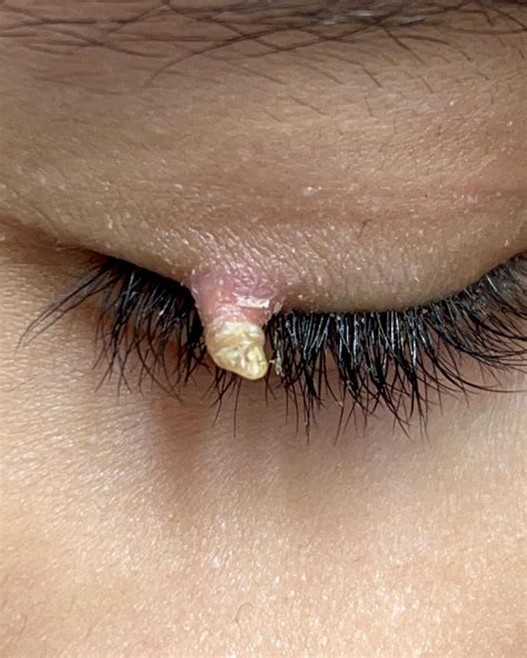 Cutaneous Horn Eyelid