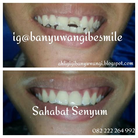 mimpi 2d gigi patah 14