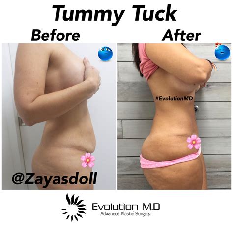 Tummy Tuck With Hernia Repair - Foundation Crack Repair