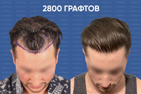 Пересадка волос до и после - Российская газета