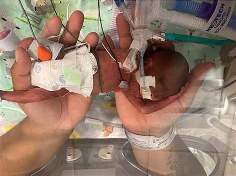 Premature Baby Born at 21 Weeks is the Youngest Ever to Survive, Look ...