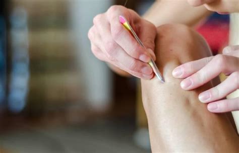 rid  ingrown hair simple tips  prevent