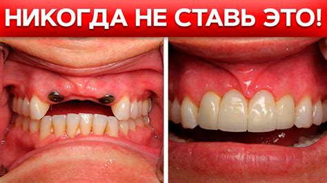 НИКОГДА не ставь ТАКИЕ импланты! Вся правда об имплантации зубов - YouTube