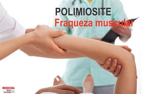 Polimiosite O Que É - Fraqueza muscular é um dos sintomas de polimiosite | Medicina - Mitos e ...