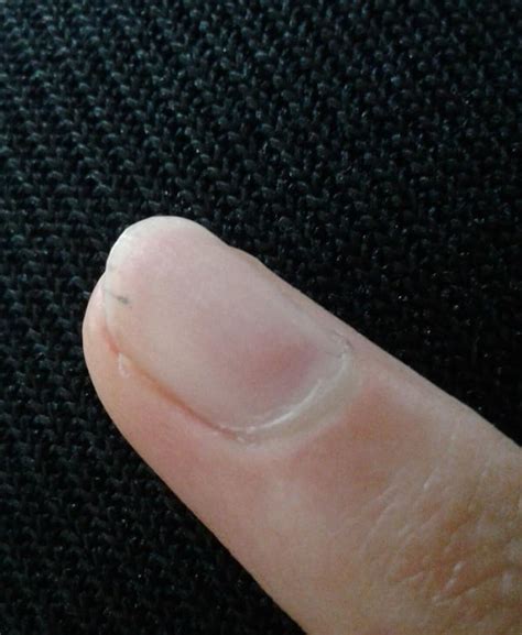 Black lines on nails : r/medical