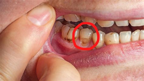 Gosto Ruim Saindo Do Dente