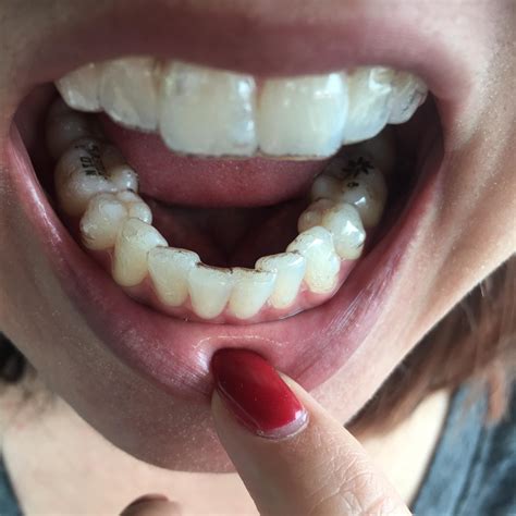 Invisalign Before And After Crooked Teeth