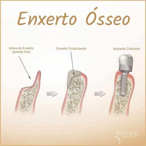 O Que Significa Enxerto