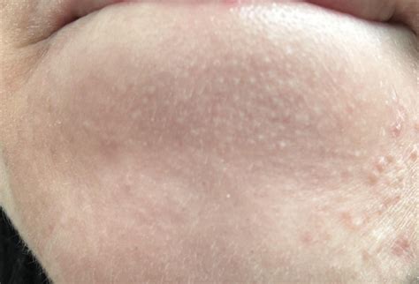 What are these bumps on my chin and how do I get rid of them? : r