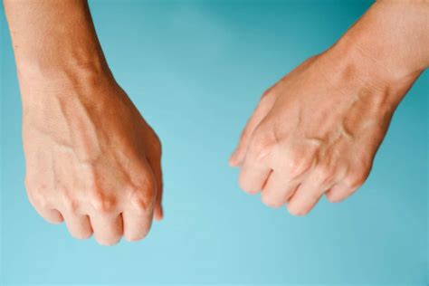 Green Veins vs. Blue Veins: What to Know (& When to Worry)