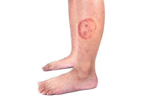Ringworm: Causes, Signs Based on Skin Color, and Treatment