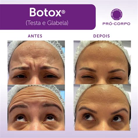 Estetica E Cosmetica Pode Aplicar Botox - 8