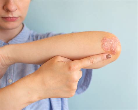 ringworm prevention helen mart