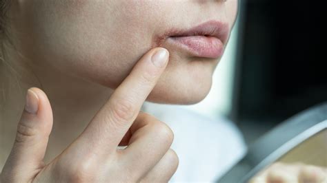 What Is Lip Eczema, And How Can You Tell If You Have It?