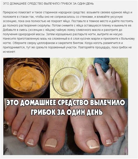 Народное средство от грибка на ногах - методы быстрого лечения ...