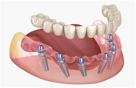 All on 6 - Spalato Dental - stomatolog Split