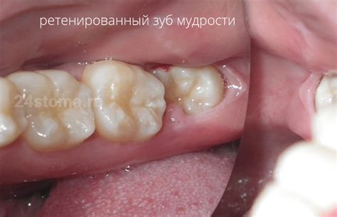 Зуб мудрости – фото, сколько их у человека, почему так называется