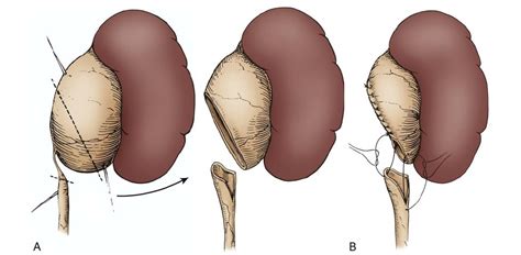 Pyeloplasty: Laparoscopic, Robotic, and RetroperitonealSurgery for Kids ...