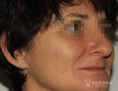 Seborrheic Keratosis - Institut Figurra