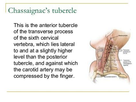 Chassagnaics tubercle... Landmark for stellate ganglion block