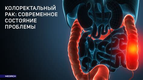 Колоректальный рак: современное состояние проблемы