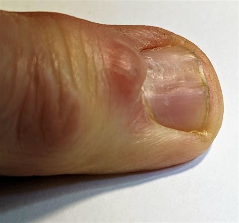 What is this nodule next to my fingernail? : r/medical_advice