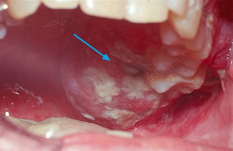 Oral cavity cancer, causes, symptoms, diagnosis, treatment & prognosis