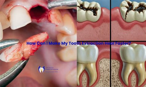 When Can You Eat Solid Food After Wisdom Tooth Extraction?