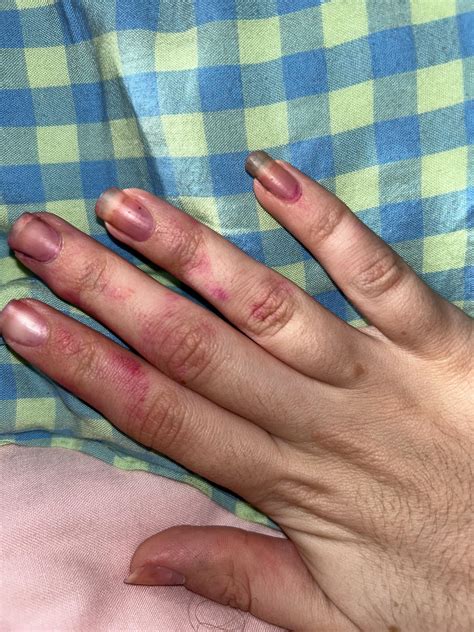 Warts