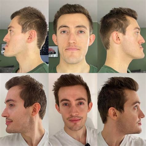 how to fix a recessed jaw