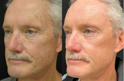 laser    encinitas ca