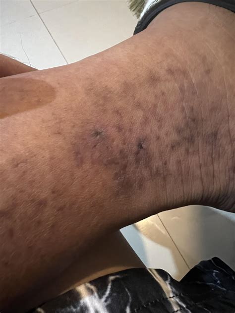 Is this Venous Stasis Dermatitis and are the wounds Venous ulcers? : r