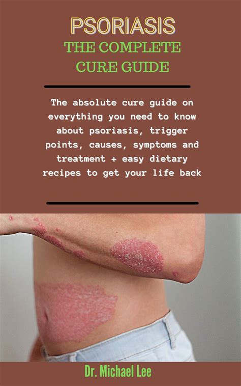 Buy Psoriasis: The Complete Cure Guide : The Absolute Cure Guide On