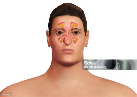 wajah manusia  sinus hidung meradang  sinusitis sinusitis