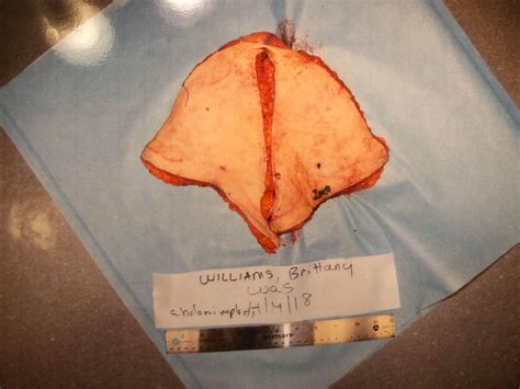 Post Operation Day 1 - Instant Loss - Conveniently Cook Your Way To