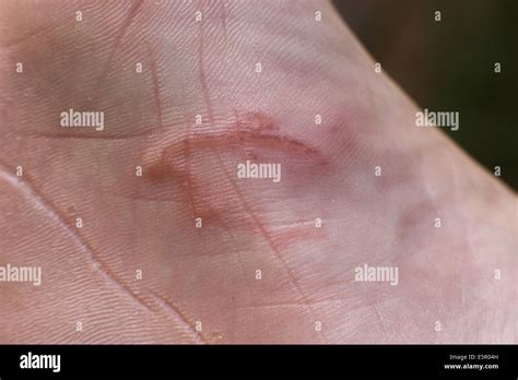Hookworm Rash In Humans