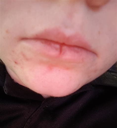 Chapped Lips Bleeding