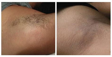 Permanent Hair Removal – Cokely Aesthetics