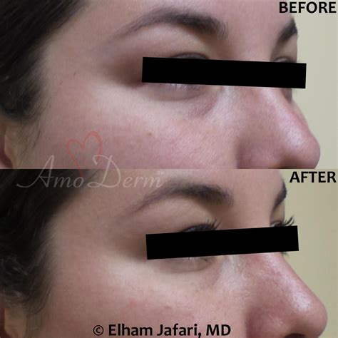 bags under eyes treatment 2