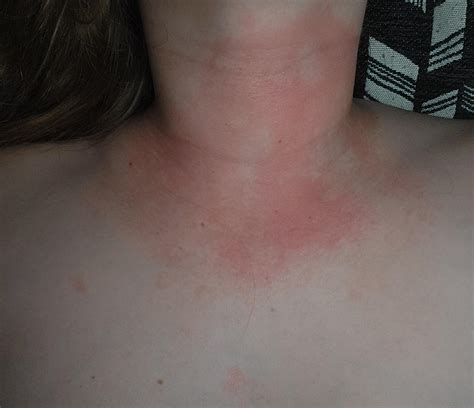 Lupus Dermatitis
