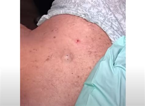giant boils exploding. Archives - New Pimple Popping Videos