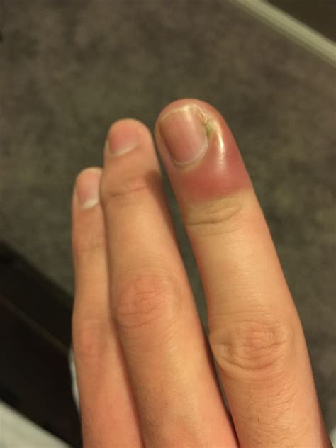 Fingertip Is Red And Swollen at Ray Devlin blog