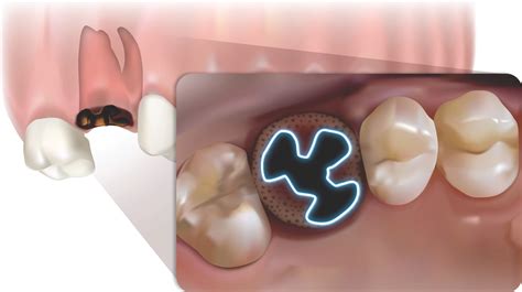 Post Extraction Molar Tooth Replacement | Southern Implants