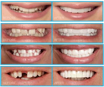Snap-On Smile® Veneers